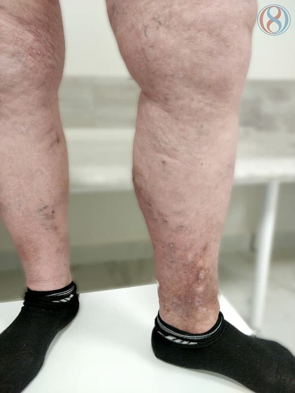 Потемнение кожных покровов при варикозной болезни ног