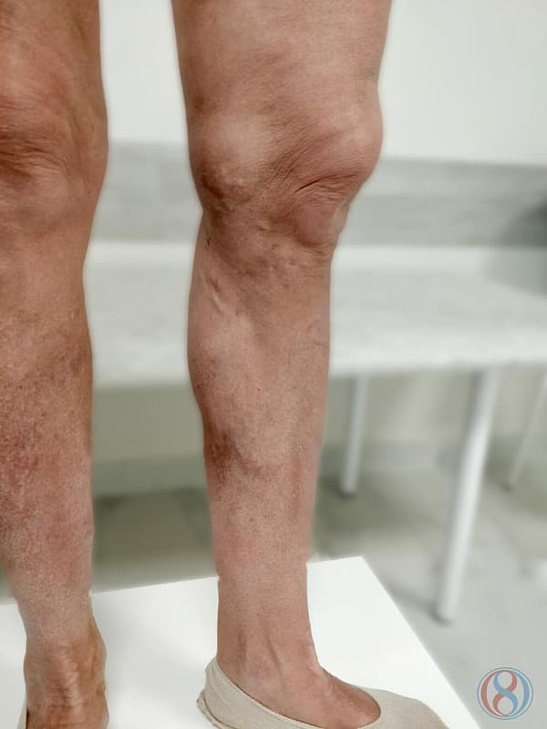 Лечение запущенной формы варикозной болезни ног
