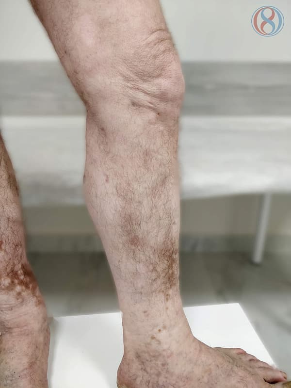 Стоимость лазерного лечения варикозной болезни ног