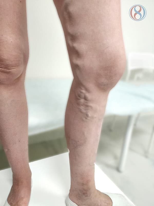 Косметический эффект после лечения варикоза ног