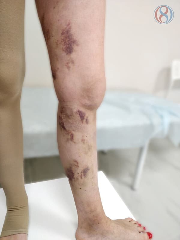 Косметический эффект после лечения варикоза ног