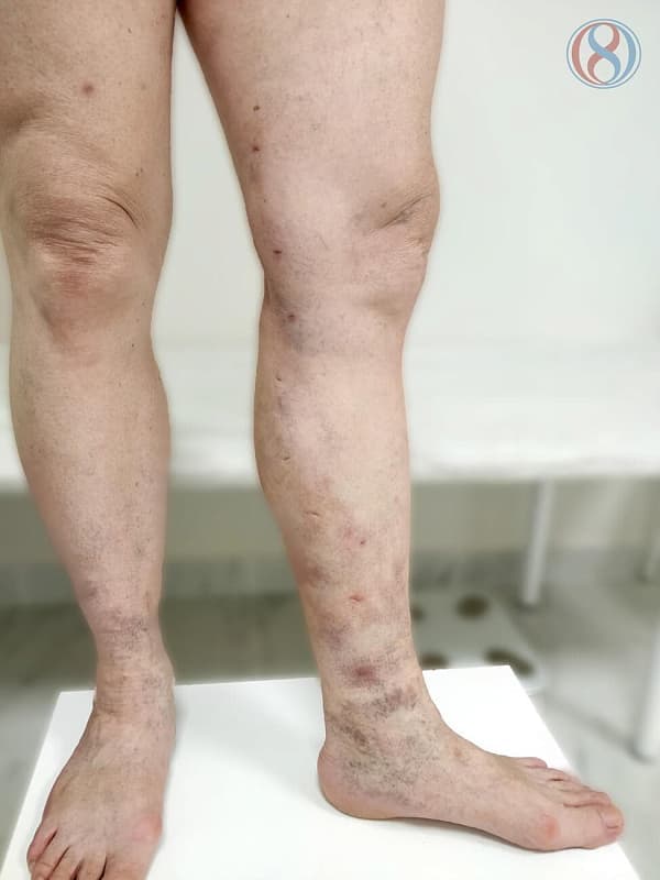 Кожная сыпь при варикозной болезни ног