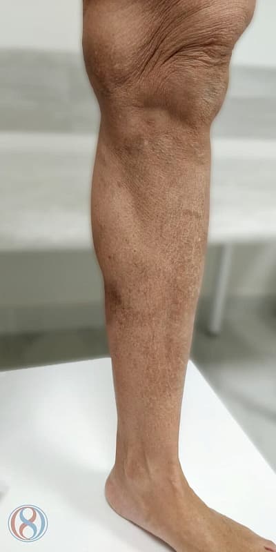 Лечение запущенной формы варикозной болезни ног