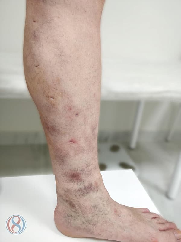 Кожная сыпь при варикозной болезни ног