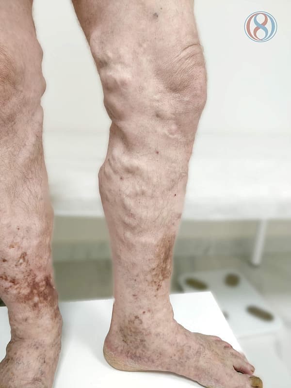 Стоимость лазерного лечения варикозной болезни ног