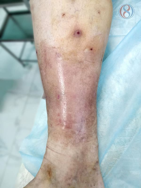Эффект от лазерного лечения варикозной болезни ног