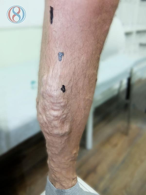 Пример устранения варикоза через один кожный прокол